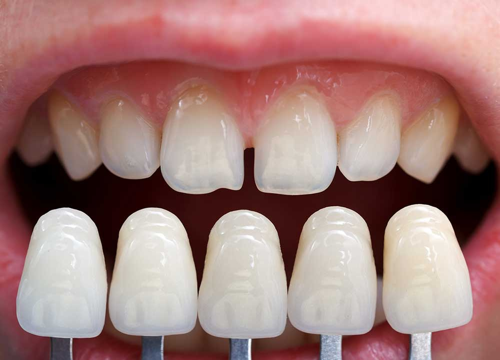Istanbul Cihangir Dental Clinic | Dental Veneers