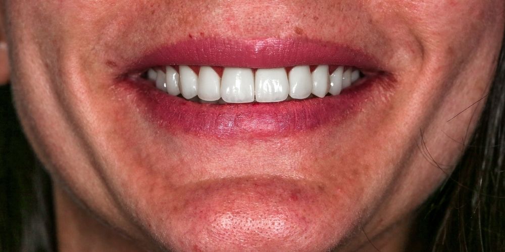 Sinus Lifting Operation in Istanbul | What is Sinus Lifting ?