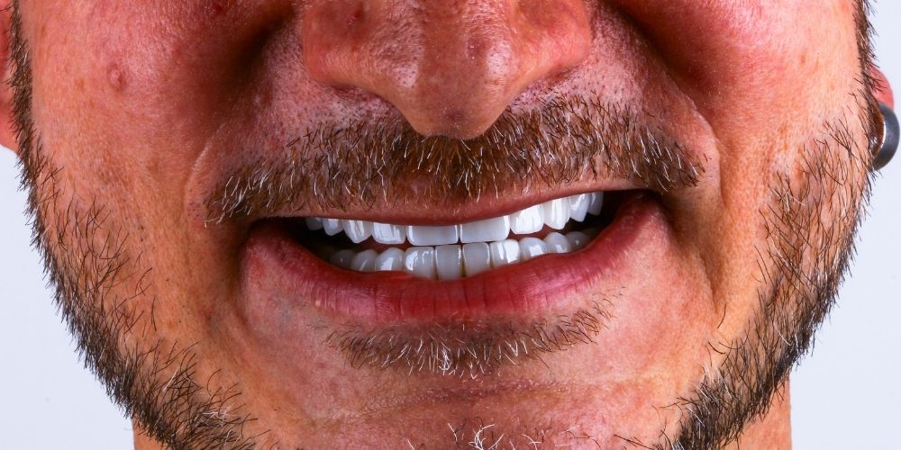 Istanbul Cihangir Dental Clinic | What is Composite Bonding?