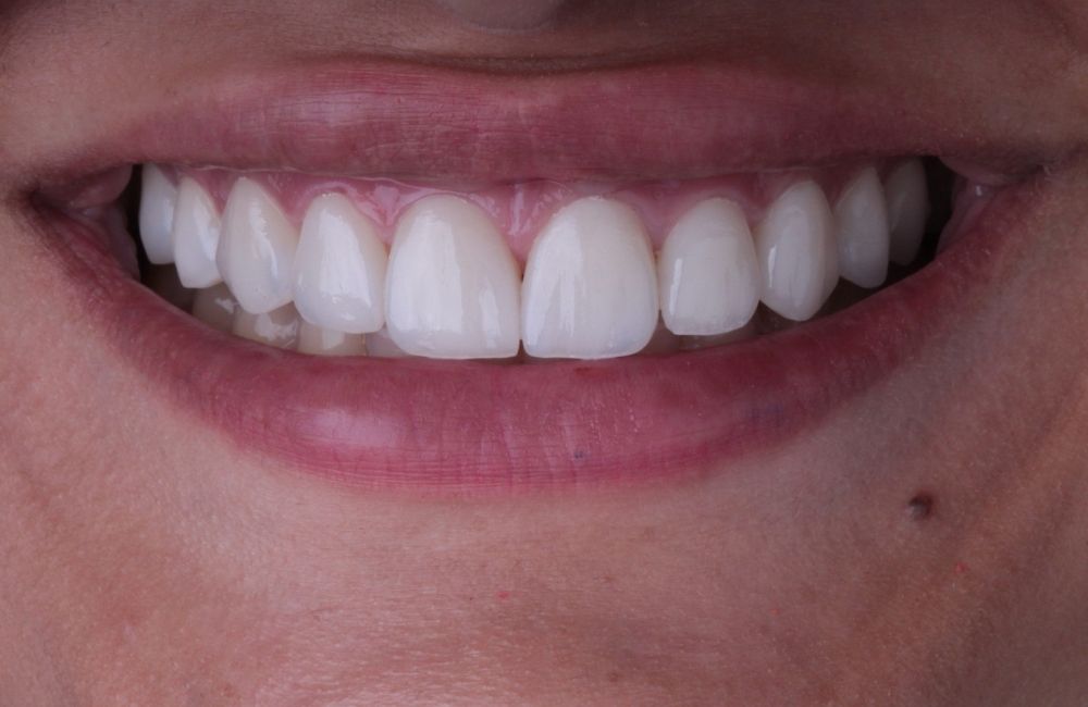 Lächeln nach der Behandlung