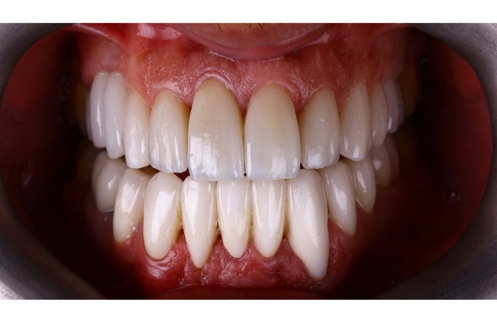 Lächeln nach der Behandlung