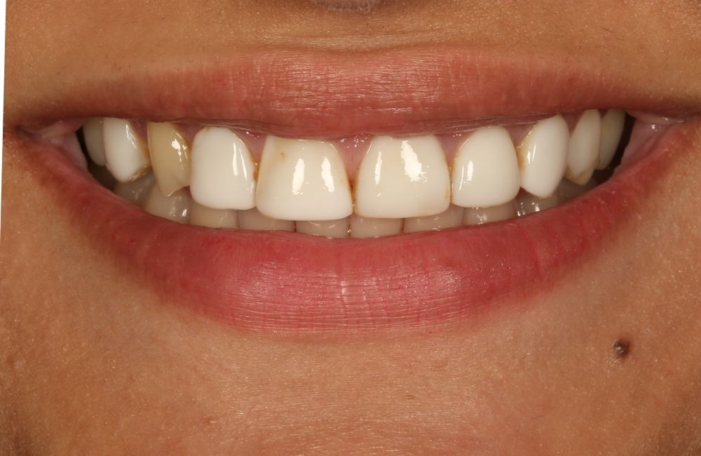 Lächeln vor der Behandlung