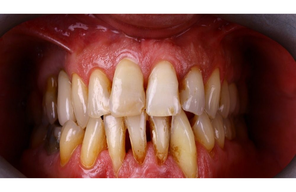 Lächeln vor der Behandlung