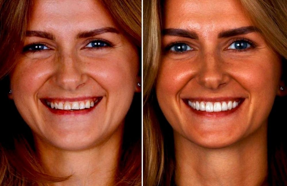 Key factors in smile design